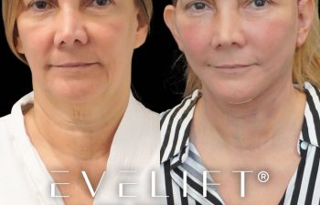 female patient before and after EVELift®