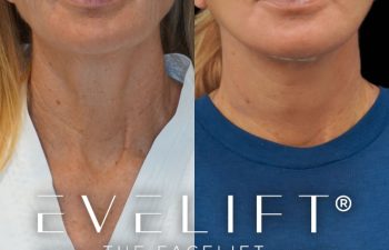 female patient before and after EVELift®