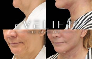 female patient before and after EVELift®