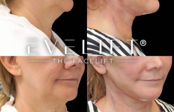 female patient before and after EVELift®