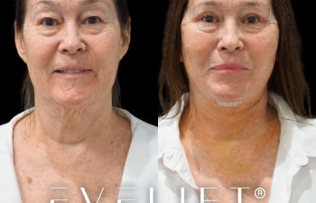 female patient before and after EVELift®