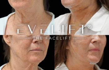 female patient before and after EVELift®