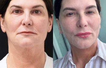 female patient before and after EVELift®