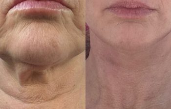female patient before and after EVELift®