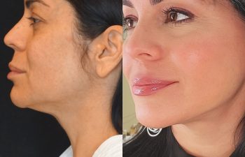 female patient before and after EVELift®