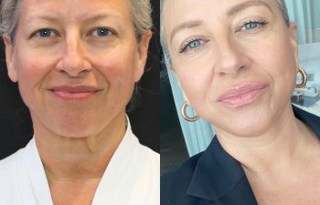 female patient before and after EVELift®