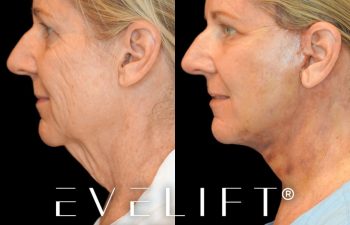 female patient before and after EVELift®