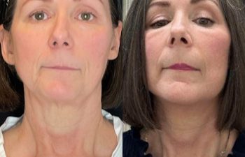 female patient before and after EVELift®
