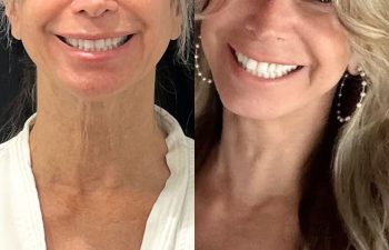 female patient before and after EVELift®