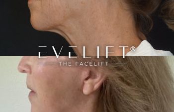 female patient before and after EVELift®