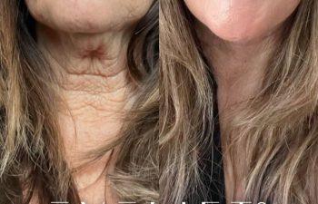 female patient before and after EVELift®