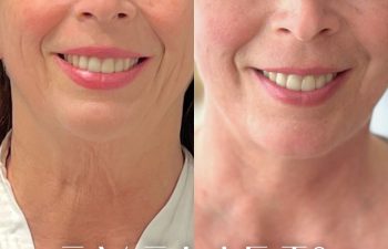 female patient before and after EVELift®
