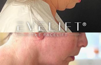 female patient before and after EVELift®