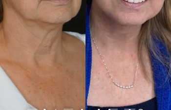 female patient before and after EVELift®