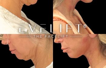 female patient before and after EVELift®