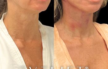 female patient before and after EVELift®