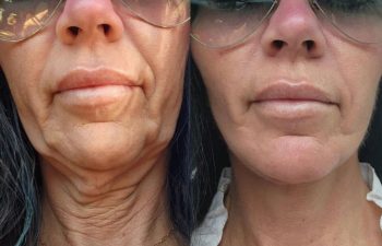 female patient before and after EVELift®