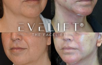 female patient before and after EVELIFT®