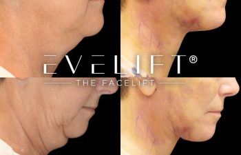 female patient before and after EVELIFT®