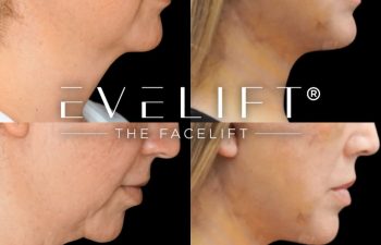 female patient before and after EVELIFT®