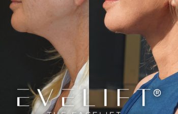 female patient before and after EVELift®