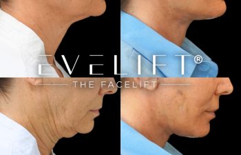 female patient before and after EVELIFT®