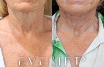female patient before and after EVELIFT®