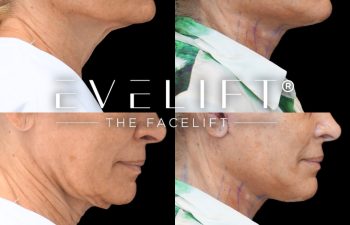 female patient before and after EVELIFT®