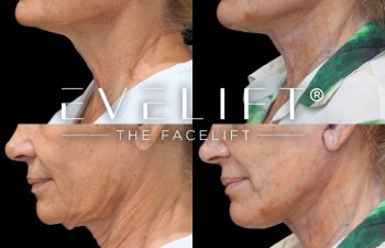 female patient before and after EVELIFT®