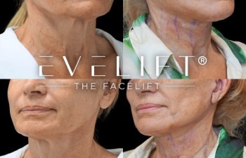 female patient before and after EVELIFT®