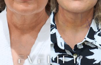 female patient before and after EVELift®
