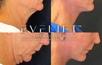 female patient before and after EVELift®