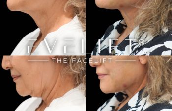 female patient before and after EVELift®