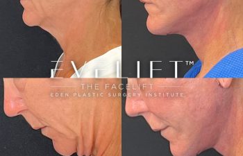 female patient before and after EVELift®