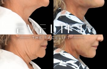 female patient before and after EVELift®