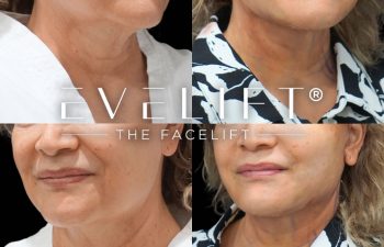 female patient before and after EVELift®