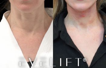 female patient before and after EVELift®