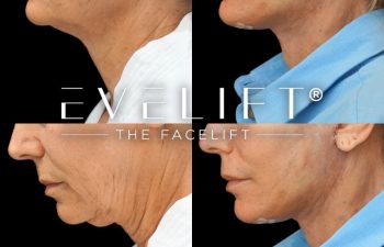 female patient before and after EVELIFT®
