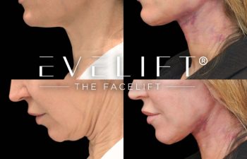 female patient before and after EVELift®