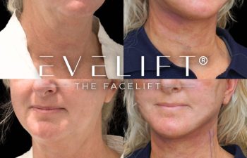 female patient before and after EVELift®