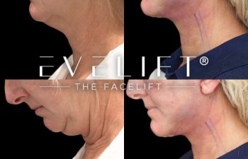 female patient before and after EVELift®