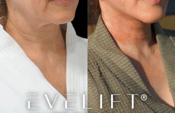 female patient before and after EVELIFT®