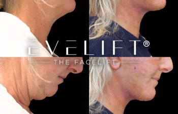 female patient before and after EVELift®