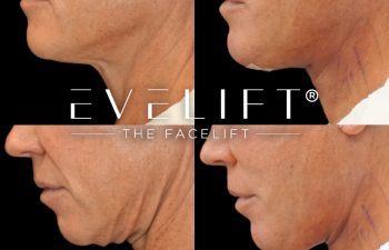 female patient before and after EVELIFT®