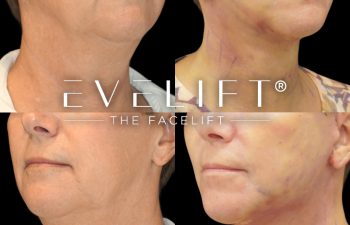 female patient before and after EVELIFT®