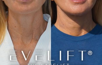 female patient before and after EVELift®
