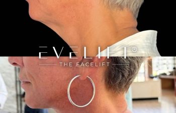 female patient before and after EVELift®