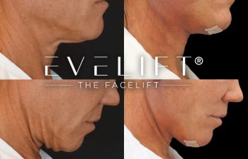 female patient before and after EVELIFT®