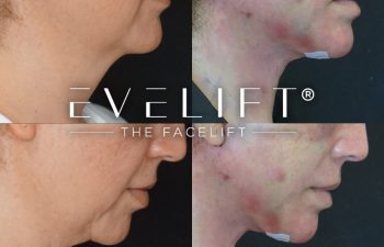 female patient before and after EVELIFT®