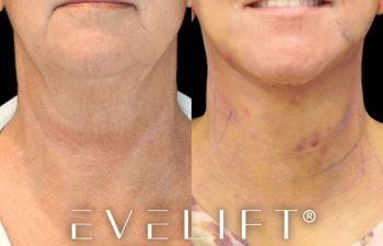 female patient before and after EVELIFT®